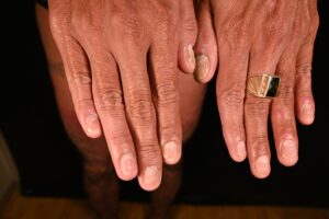 Người bệnh vảy nến nên thường xuyên kiểm tra móng tay, móng chân để phát hiện biểu hiện của vảy nến móng (Nguồn ảnh: Bệnh viện Da Liễu TP.HCM)