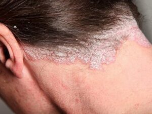 Dầu gội chuyên biệt, sản phẩm dạng mỡ, steroid thoa và lotion/gel vitamin D có thể điều trị vảy nến da đầu