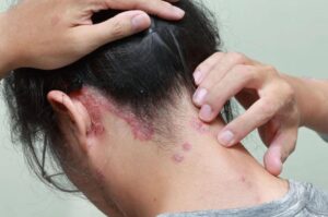 Điều trị vảy nến ở các vị trí đặc biệt như da đầu bằng thuốc tiêm sinh học có thể kiểm soát sạch hoàn toàn hoặc gần như hoàn toàn sang thương (Nguồn: internet)